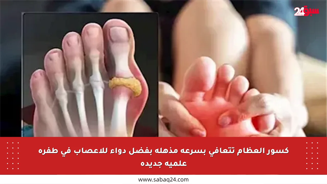 كسور العظام تتعافى بسرعة مذهلة بفضل دواء للأعصاب في طفرة علمية جديدة